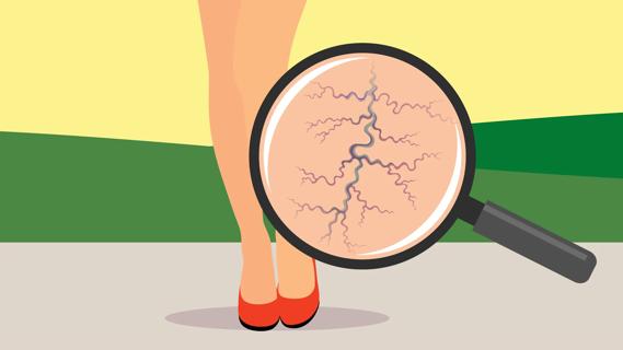 Pair of bare legs in shoes, with magnifying glass showing enlarged veins