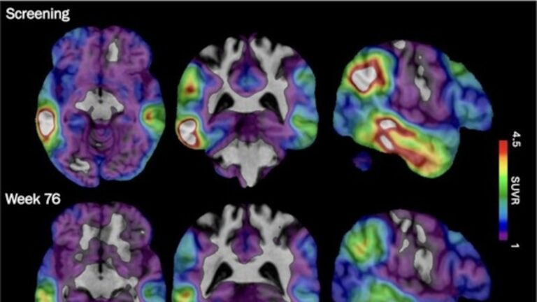 Experimental Alzheimer’s drug shows some promise as researchers hunt new approaches Experimental Alzheimer's drug shows some promise as researchers hunt new approaches