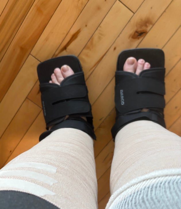 The daily compression bandaging the author needs because of the lipedema.