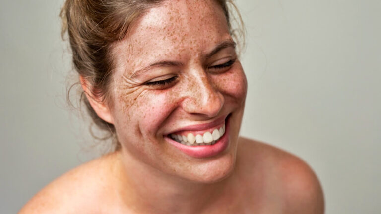 When Birthmarks Tell A Bigger Story: Understanding Rare Genetic Disorder NF1 When Birthmarks Tell A Bigger Story: Understanding Rare Genetic Disorder NF1