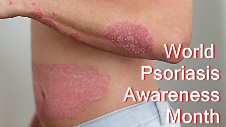 Understanding Psoriasis And The New Thinking Around Its Management