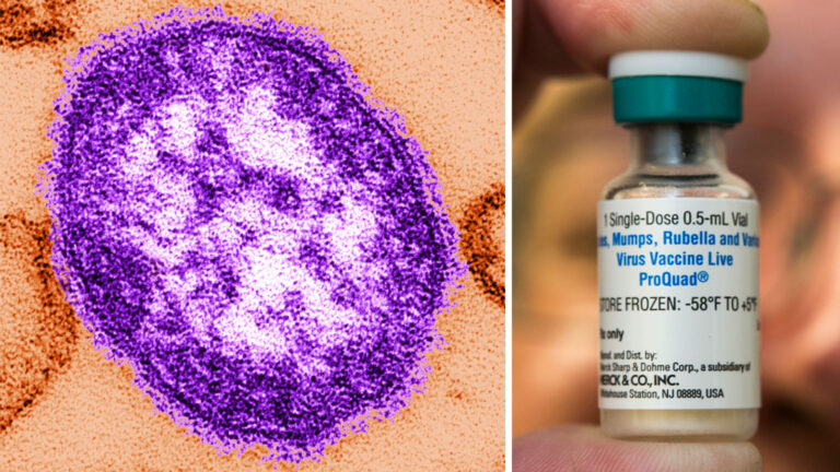 Health officials investigate possible measles exposure in Buncombe County