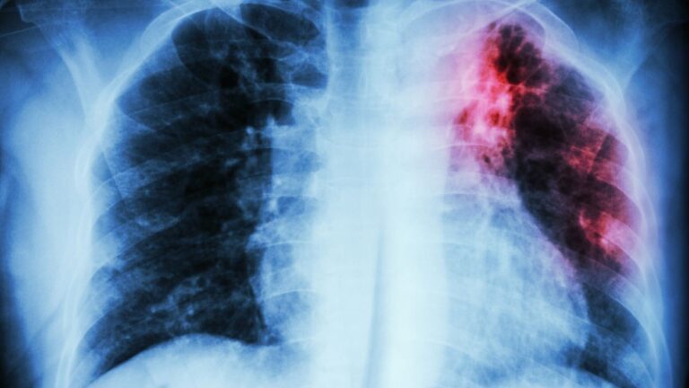 State health officials probe tuberculosis exposure at Summerville High School State health officials probe tuberculosis exposure at Summerville High School
