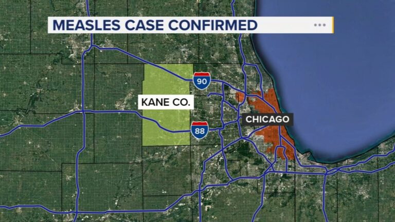 Measles case confirmed in Kane County; health officials working to notify potentially exposed people