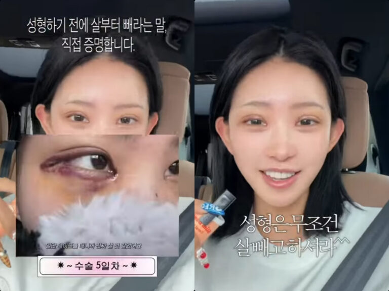 'Choi Jin-sil's Daughter' Choi Jun-hee, 55kg Weight Loss → 3rd Double Eyelid Surgery: "You Must Lose Weight Before Plastic Surgery"