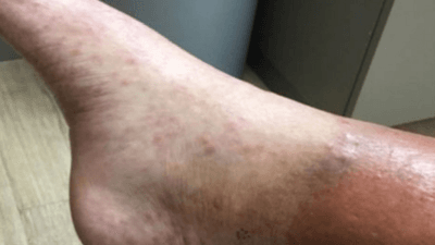 Leprosy 4.PNG