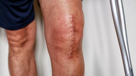 Periprosthetic joint infection after knee replacement