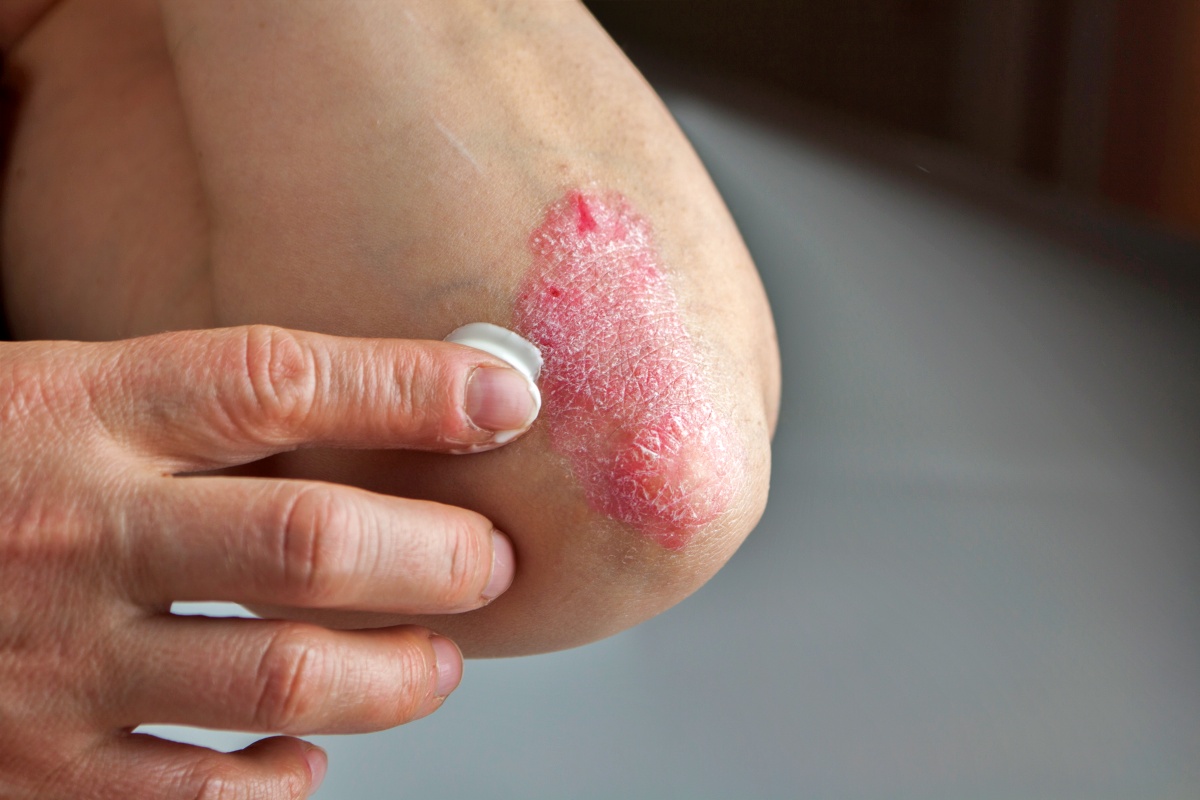 Healthy lifestyle practices can help manage psoriasis
