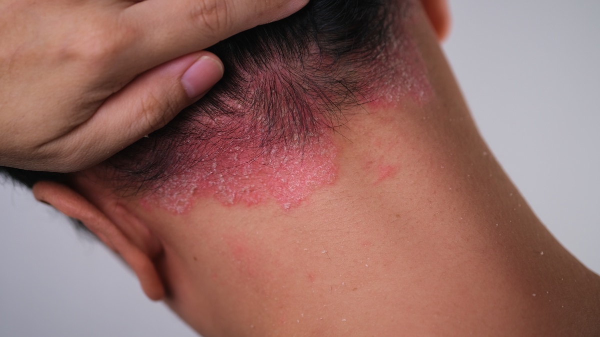 Psoriasis