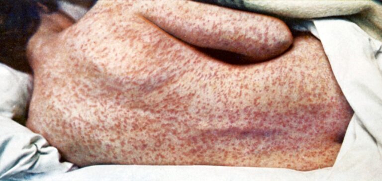 There is no treatment for measles, but vaccines have been proven to be safe and effective at preventing the disease. There is no treatment for measles, but vaccines have been proven to be safe and effective at preventing the disease.