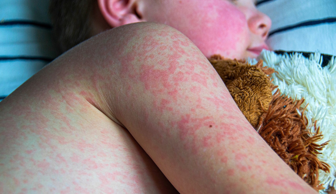 Measles cases surge