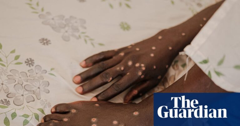 Mpox is back – and in new countries. How can this outbreak be contained? Mpox is back – and in new countries. How can this outbreak be contained?