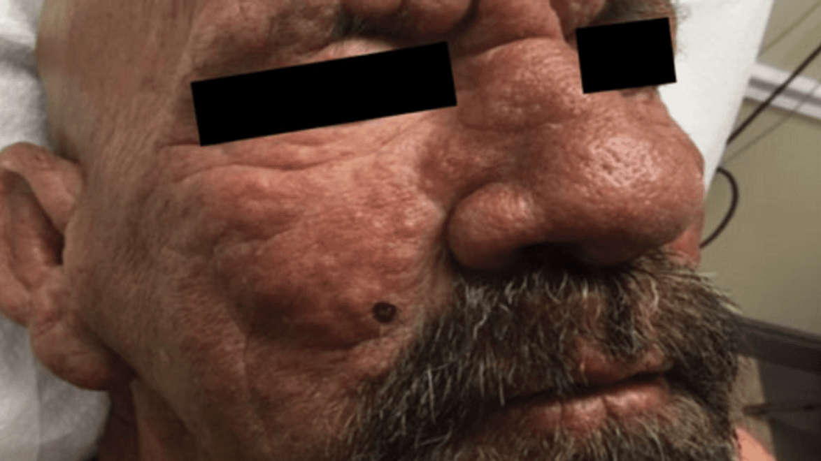 Leprosy.PNG