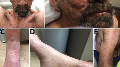 Leprosy 2.jpg