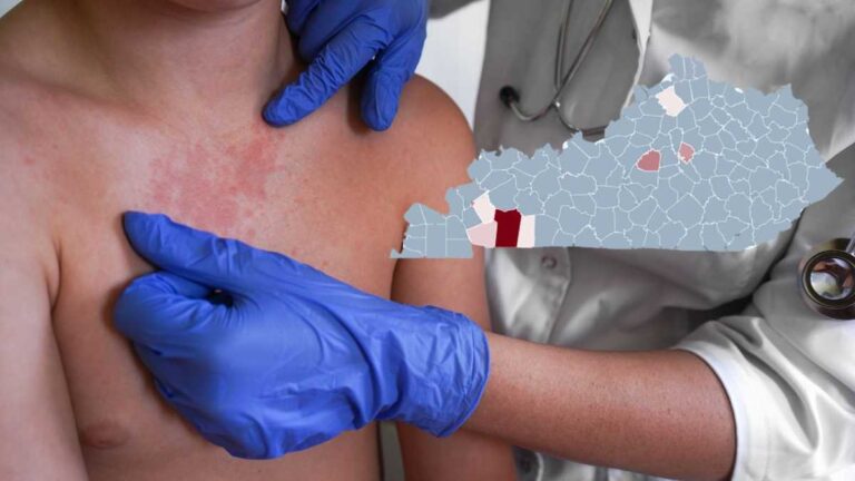 Kentucky measles cases rise to 24 as outbreak expands to new county Kentucky measles cases rise to 24 as outbreak expands to new county