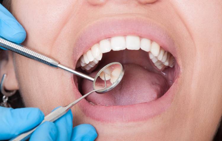 Close-up of an adult's open mouth during a dental exam, with a gloved dentist holding a mirror reflecting a lower molar.