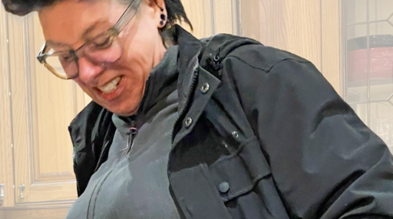 I Lost 85 Pounds. Then I Had My Loose Skin Removed… And Did Something With It That Shocks People I Lost 85 Pounds. Then I Had My Loose Skin Removed... And Did Something With It That Shocks People