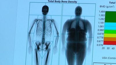 Eye on Health: Foot condition is a possible side affect of weight loss drugs