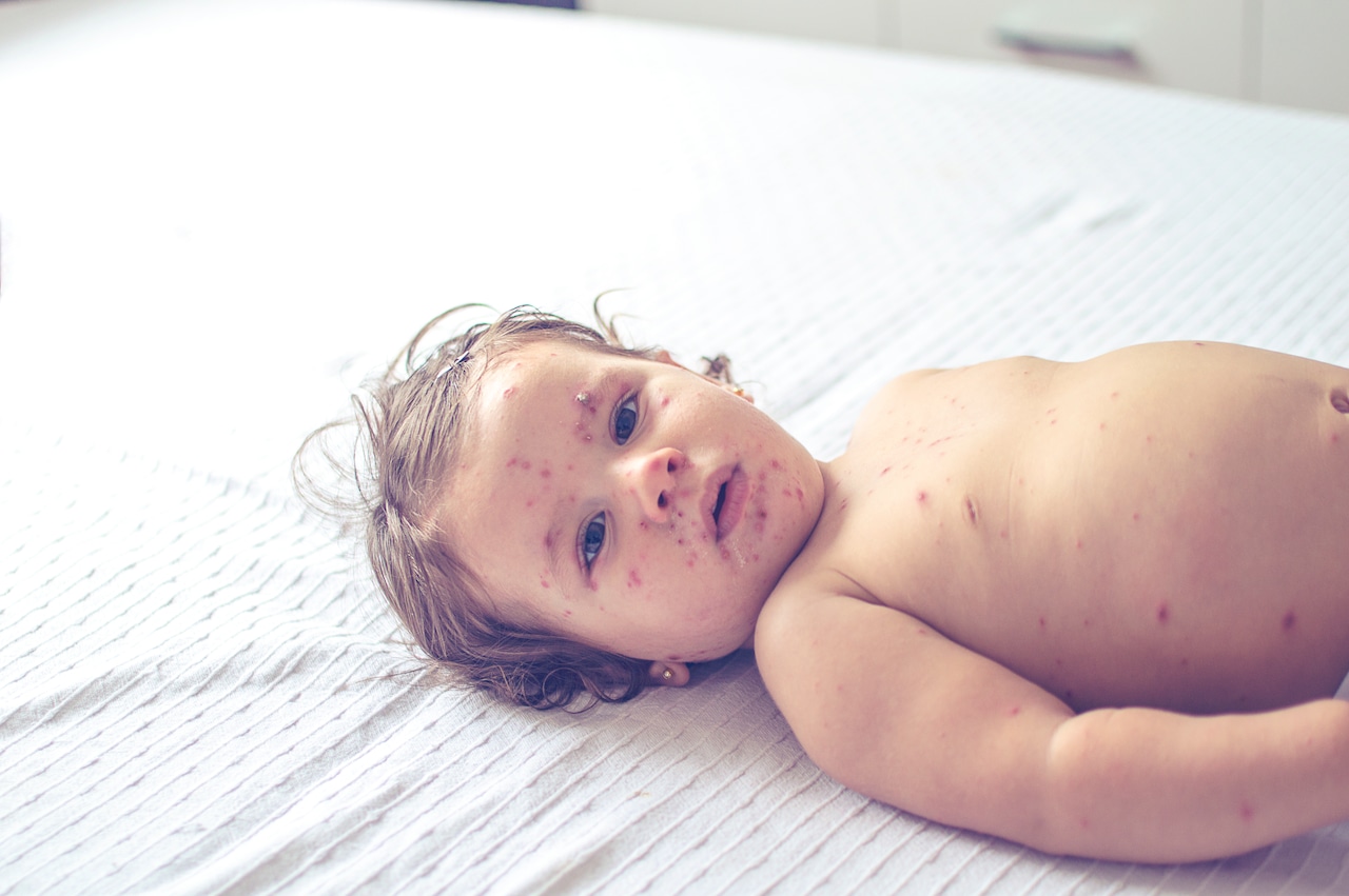 Measles in NYC