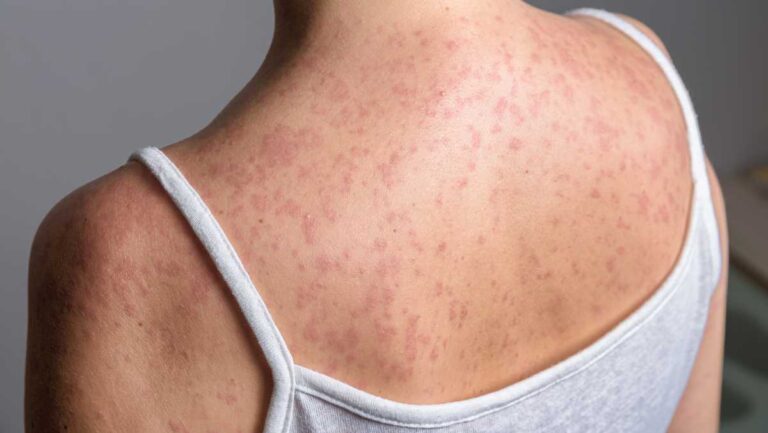 Iowa officials identify places visited during measles contagion Iowa officials identify places visited during measles contagion