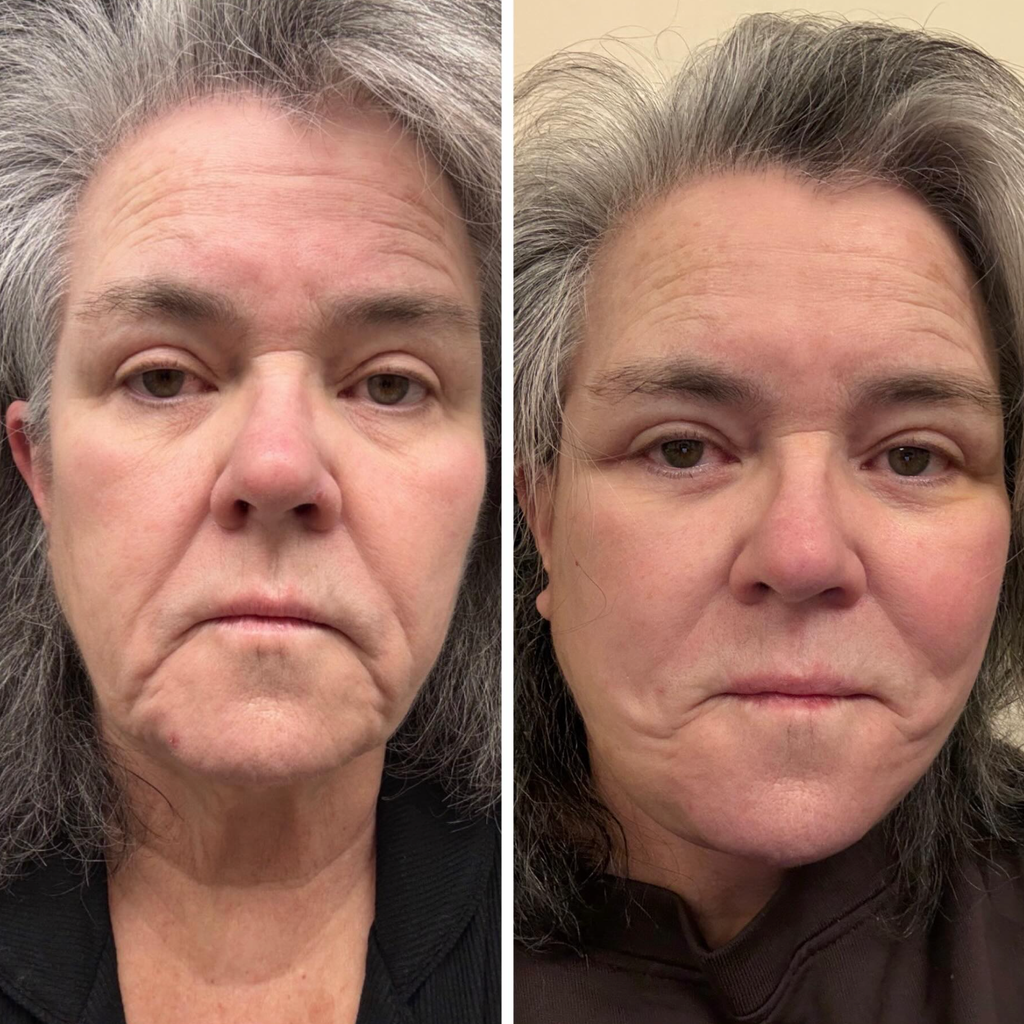 Rosie shared the results of her facelift