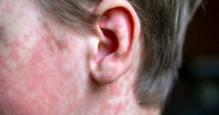 KY Health Department confirms potential measles exposure in Richmond, Olive Hill