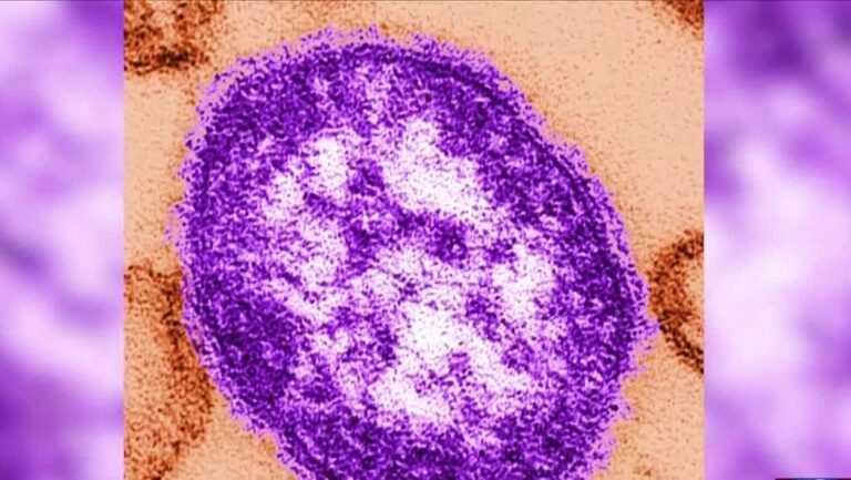 Wisconsin measles outbreak grows to 92 cases in three counties