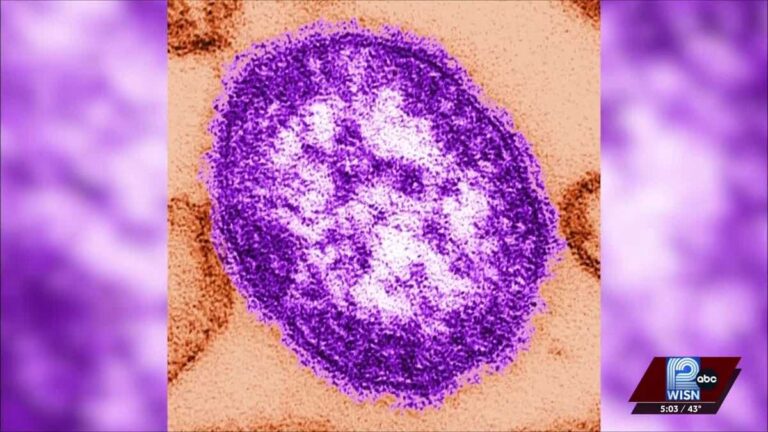 Measles cases surge to 15 in Iowa and Lafayette counties as Wisconsin warns of more spread