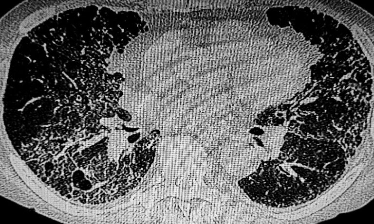 U-I-P Score Predicted Disease Progression in Smokers with Fibrotic IIP U-I-P Score Predicted Disease Progression in Smokers with Fibrotic IIP