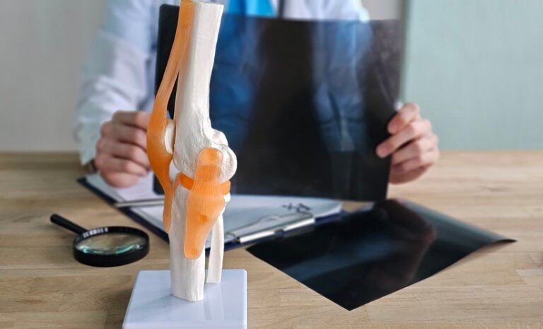 Lymphatic Vessels Enter Bone in Disease, Not Repair Lymphatic Vessels Enter Bone in Disease, Not Repair