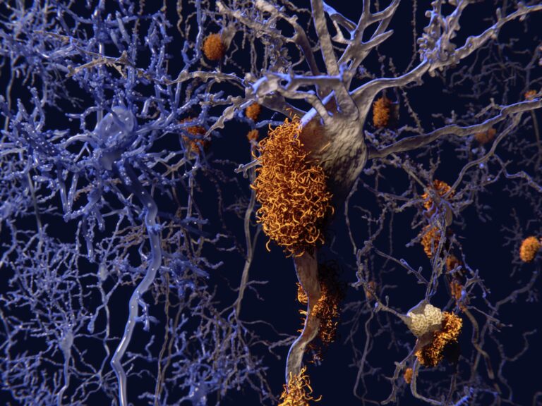 FDA Approves Tauklarify for Tau PET Imaging in Alzheimer Disease