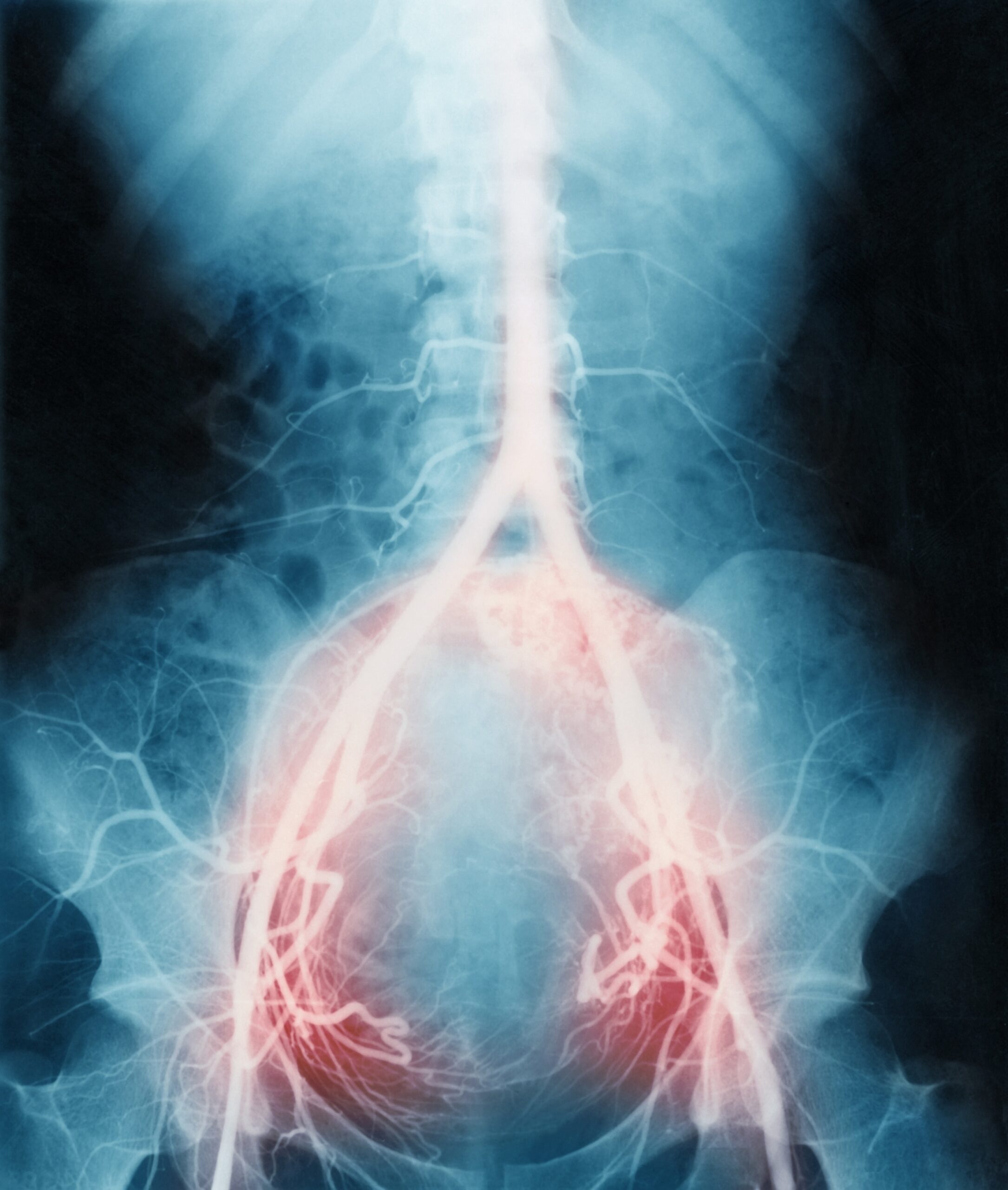 An abdominal angiogram X-ray showing highlighted red areas indicating blood flow in the pelvic region