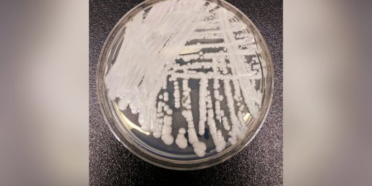‘Superbug’ fungus has spread to half the US. Should you be concerned?