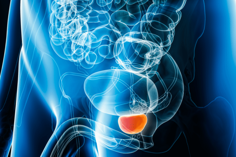 Foods making up most Americans’ diets linked to higher prostate cancer risk