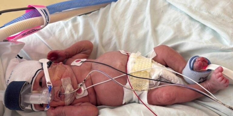 Baby born at 12.5 ounces graduates NICU after 375 days in the hospital Baby born at 12.5 ounces graduates NICU after 375 days in the hospital
