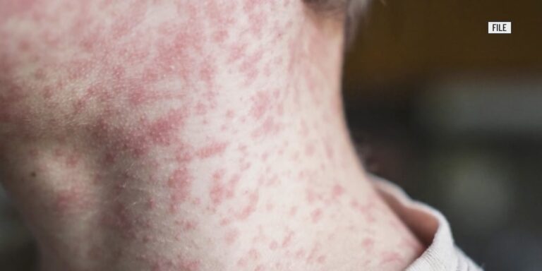 Health officials identify potential exposure locations in Madison County