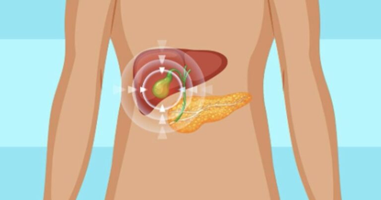 Obesity increases the risk of gallstones