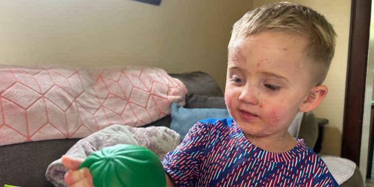 NKY boy hospitalized with staph infection after hand, foot and mouth disease