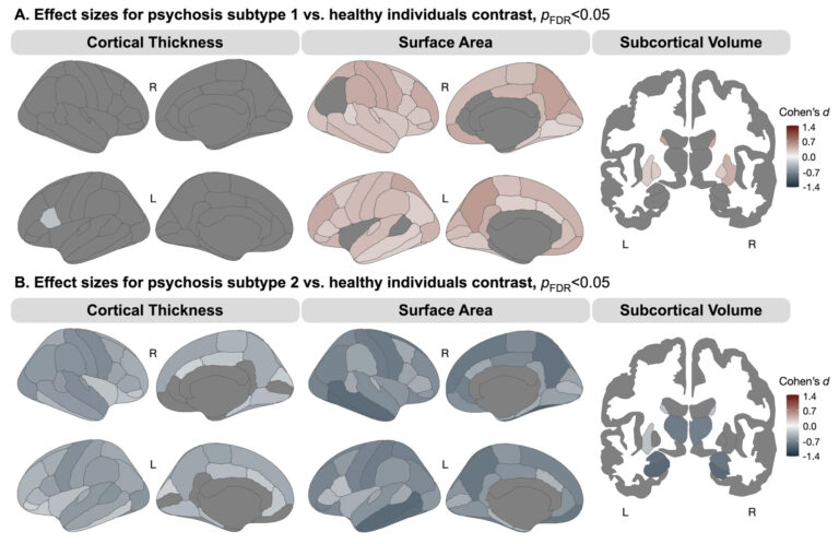 Brain scan method may improve diagnosis, treatment of psychosis