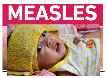 Public Health Notice: Officials Investigate Confirmed Measles Case in Allegany County Public Health Notice: Officials Investigate Confirmed Measles Case in Allegany County