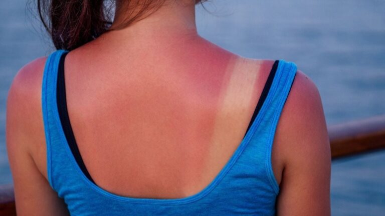 Just One Intense Sunburn Can Change Your Health Forever, Research Shows Just One Intense Sunburn Can Change Your Health Forever, Research Shows