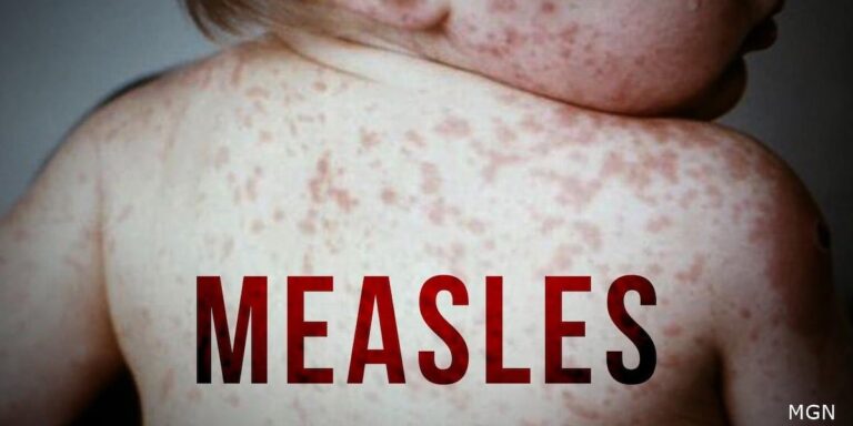 Measles cases rising in rural New York, says Jefferson Co. Public Health