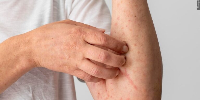 Tioga County Public Health investigates confirmed measles case in unvaccinated resident Tioga County Public Health investigates confirmed measles case in unvaccinated resident