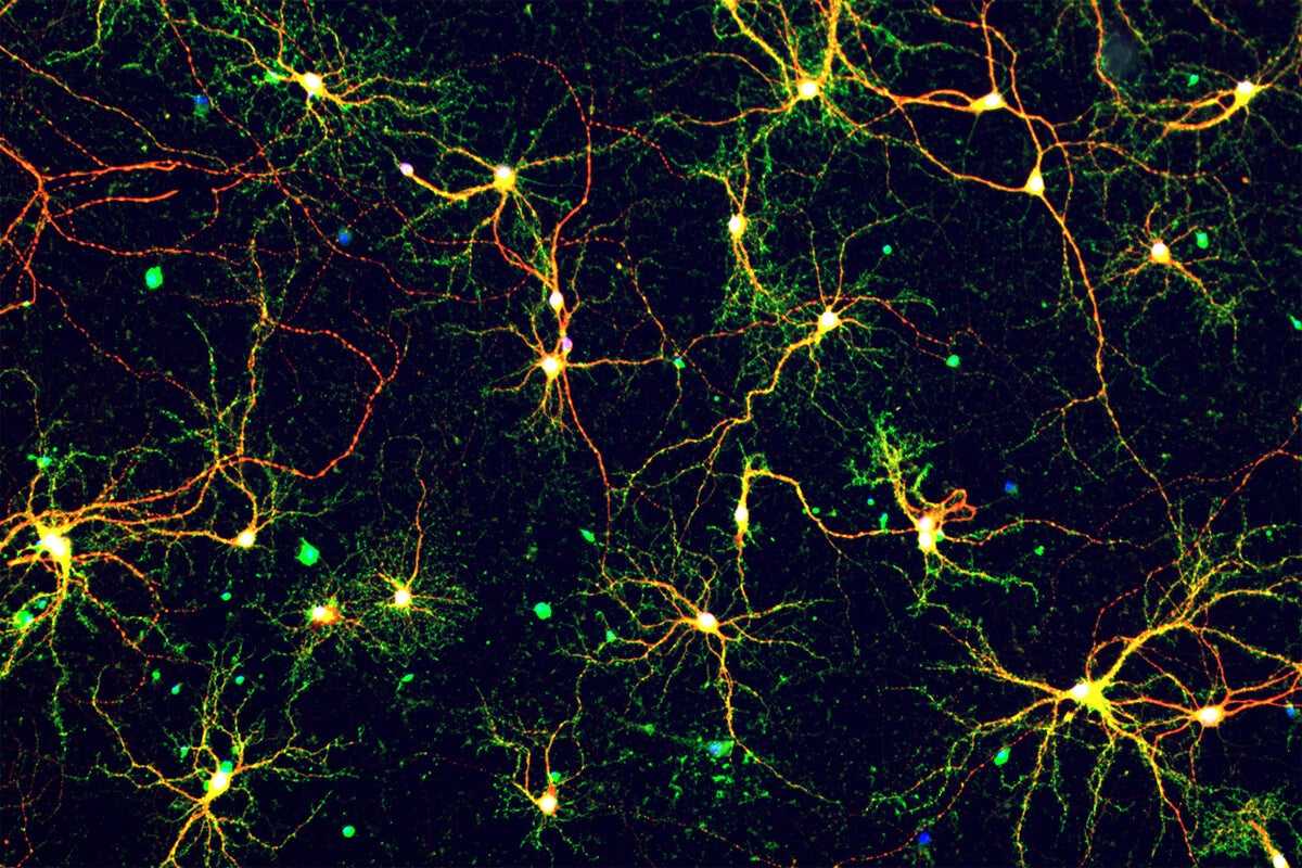 "Oligomeric" amyloid beta (green) bound to hippocampal neurons.