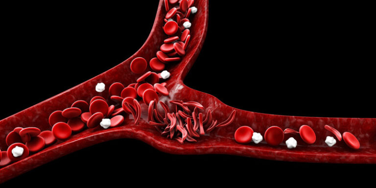 Binghamton researchers explore resilience in adults with Sickle Cell Disease