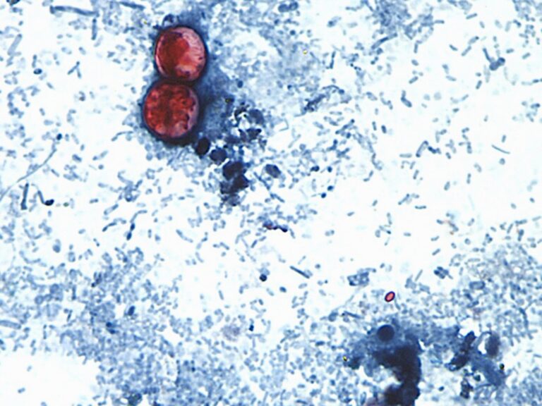 US announces first two deaths from cyclospora outbreak in Michigan US announces first two deaths from cyclospora outbreak in Michigan