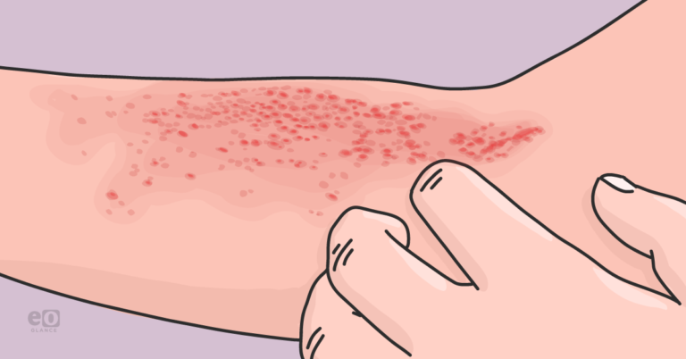 Atopic dermatitis linked to higher retinal detachment risk