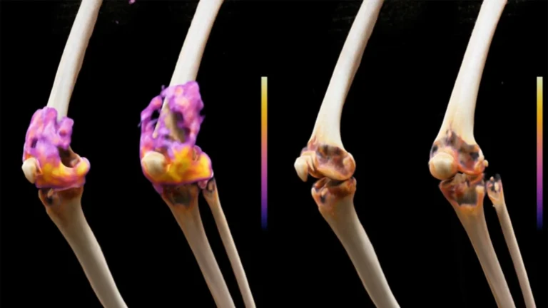 A cancer therapy put severe rheumatoid arthritis into remission