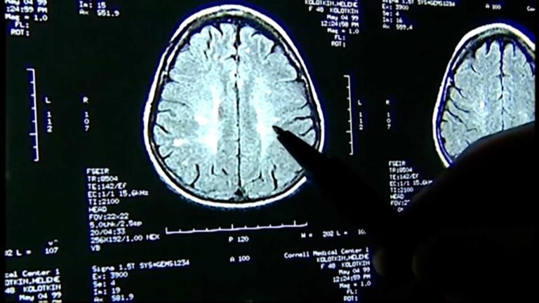 At least 1 in 4 NFL players had brain disease CTE, Mass General Brigham study finds At least 1 in 4 NFL players had brain disease CTE, Mass General Brigham study finds