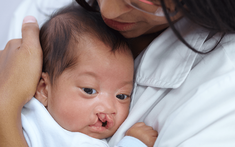 a young female nurse holding a baby who has a cleft palate